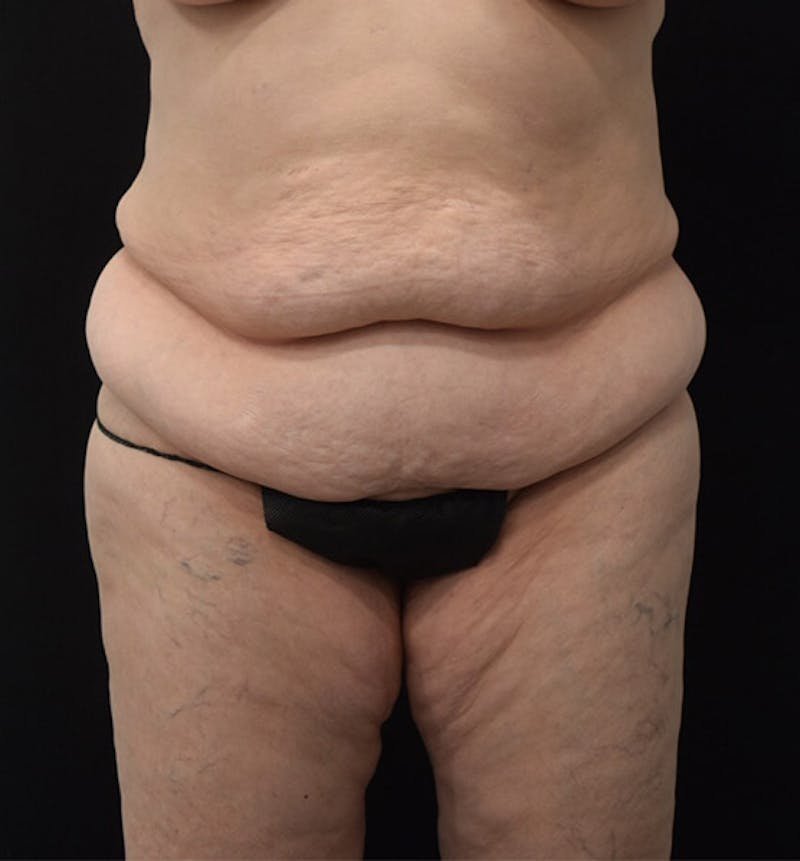 Lower Body Lift Before & After Gallery - Patient 102392631 - Image 1