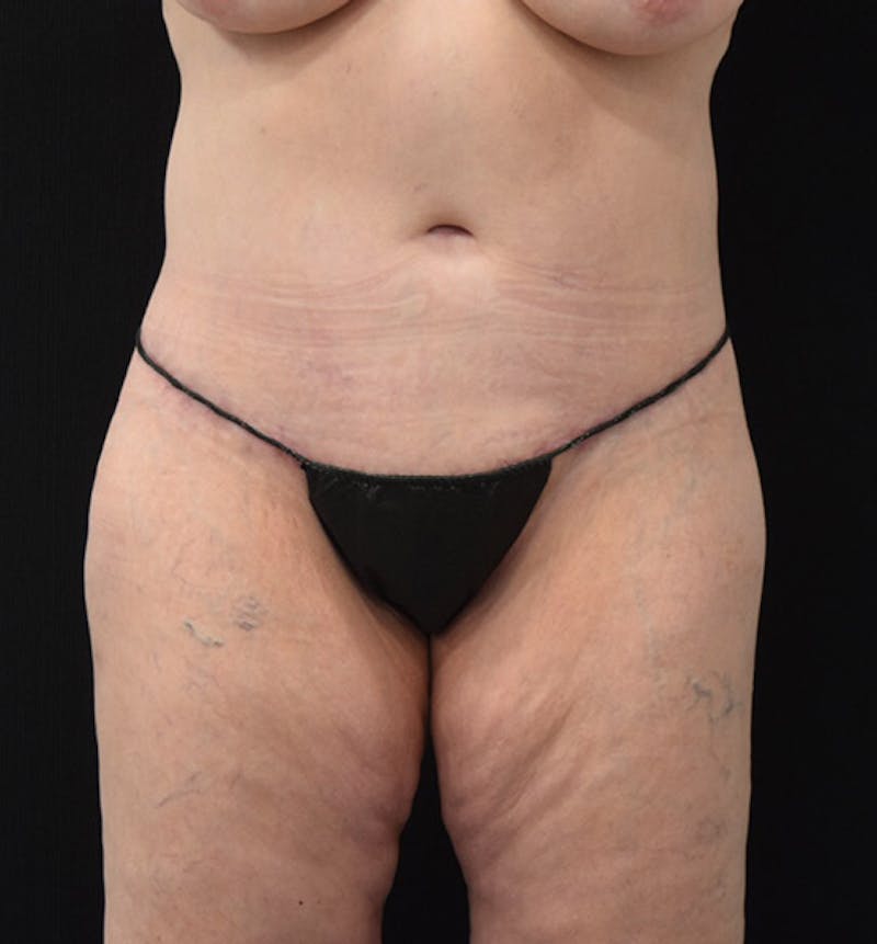 Lower Body Lift Before & After Gallery - Patient 102392631 - Image 2