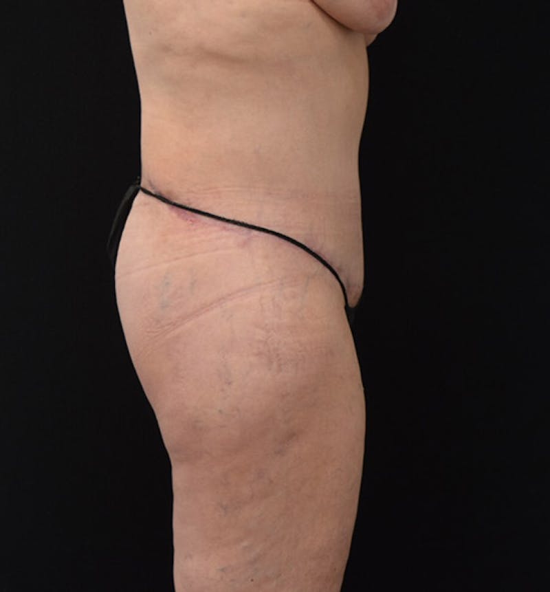 Lower Body Lift Before & After Gallery - Patient 102392631 - Image 6