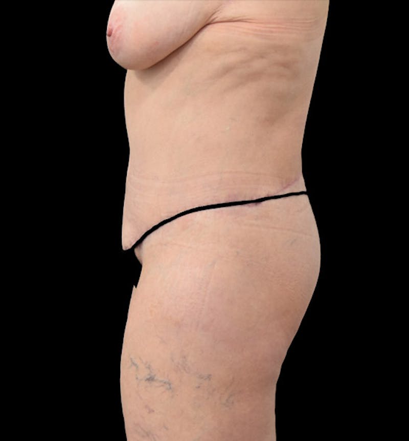 Lower Body Lift Before & After Gallery - Patient 102392631 - Image 10