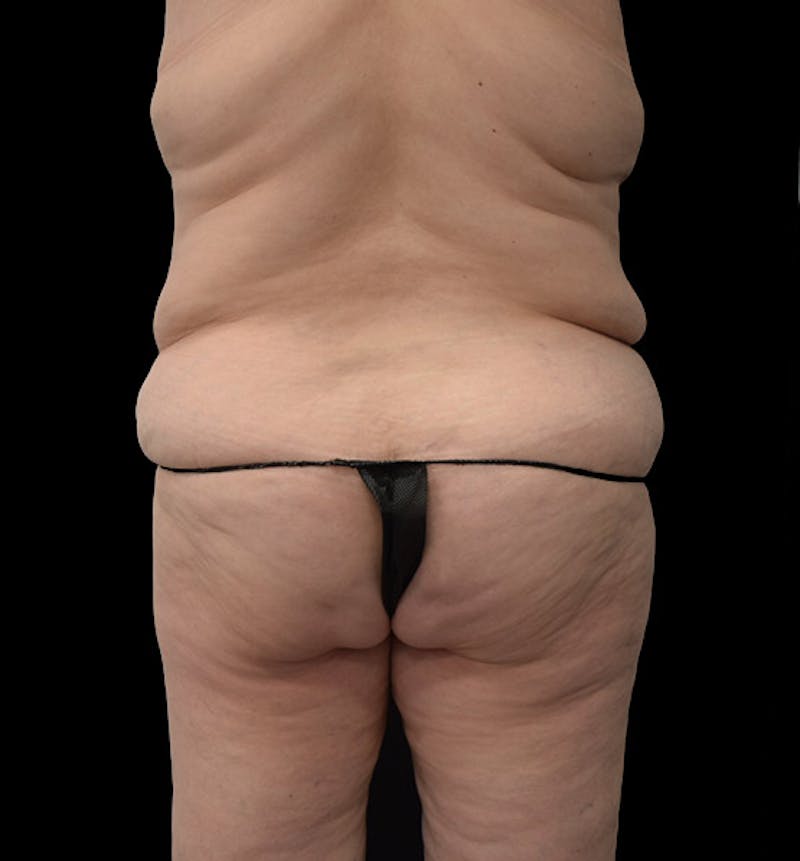 Lower Body Lift Before & After Gallery - Patient 102392631 - Image 11