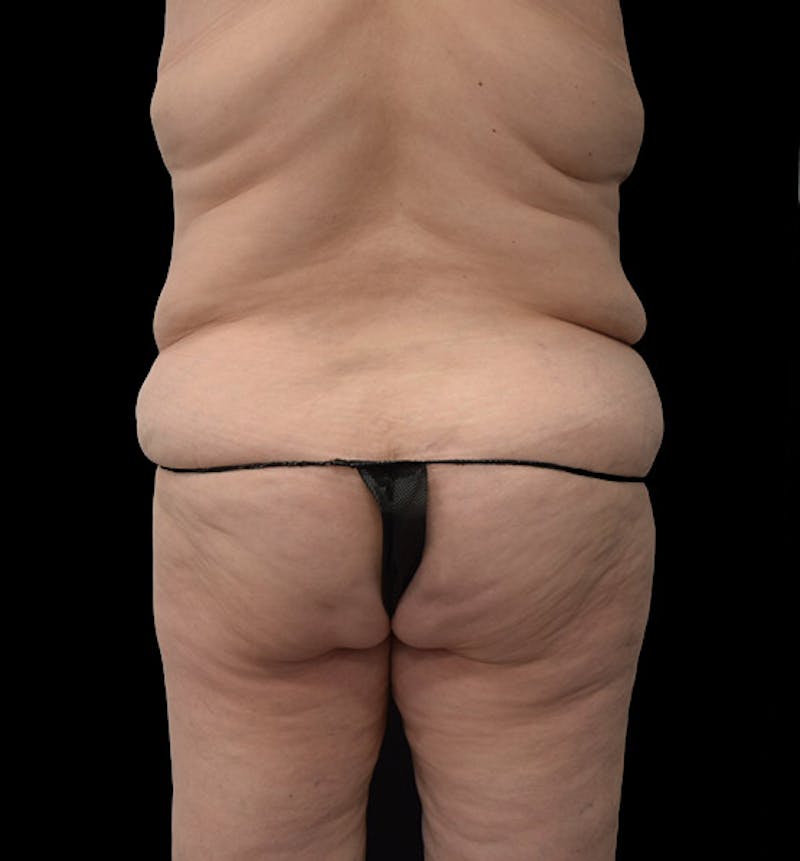 Lower Body Lift Before & After Gallery - Patient 102392631 - Image 11