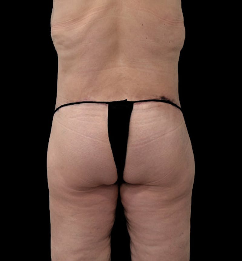 Lower Body Lift Before & After Gallery - Patient 102392631 - Image 12