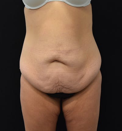 Lower Body Lift Before & After Gallery - Patient 102400385 - Image 1