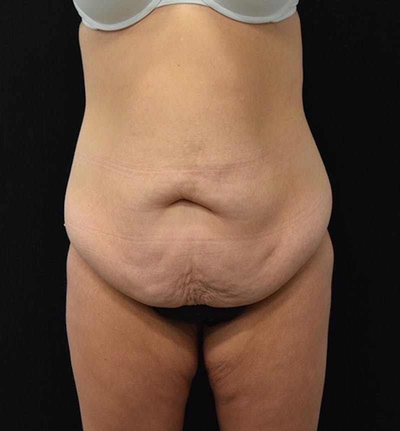 Lower Body Lift Before & After Gallery - Patient 102400385 - Image 1