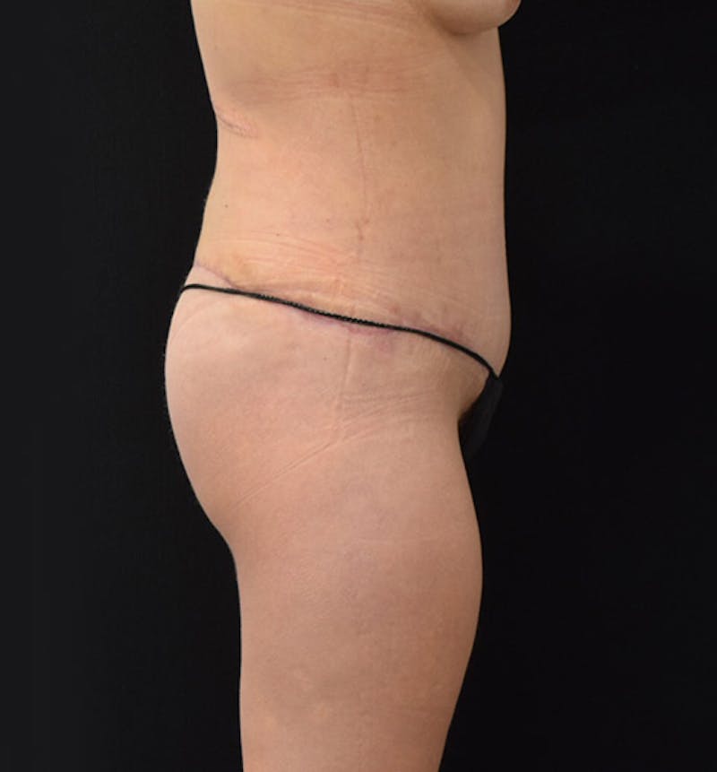 Lower Body Lift Gallery - Patient 102400385 - Image 6