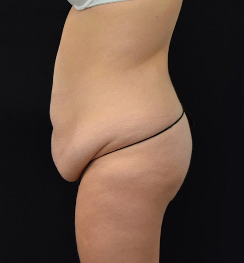 Lower Body Lift Before & After Gallery - Patient 102400385 - Image 9