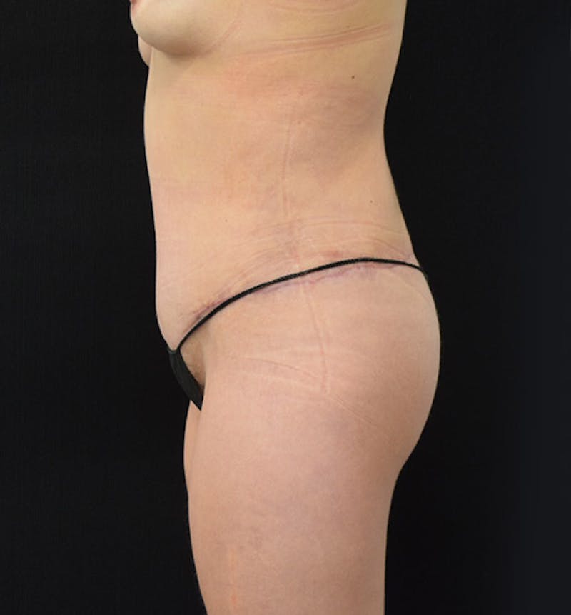 Lower Body Lift Before & After Gallery - Patient 102400385 - Image 10