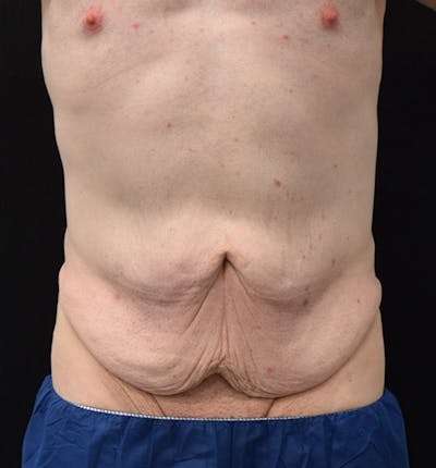 Male Lower Body Lift Before & After Gallery - Patient 148037524 - Image 1