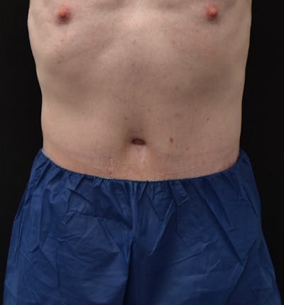 Male Lower Body Lift Before & After Gallery - Patient 148037524 - Image 2