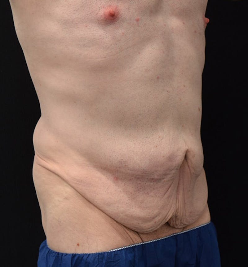 Male Lower Body Lift Before & After Gallery - Patient 148037524 - Image 3