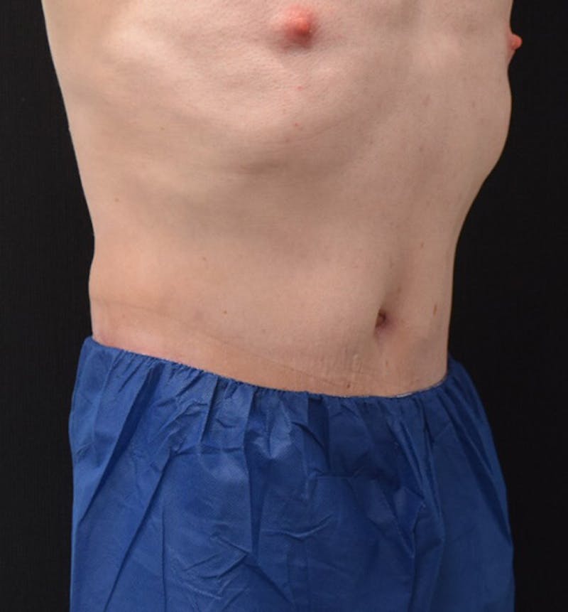 Male Lower Body Lift Before & After Gallery - Patient 148037524 - Image 4