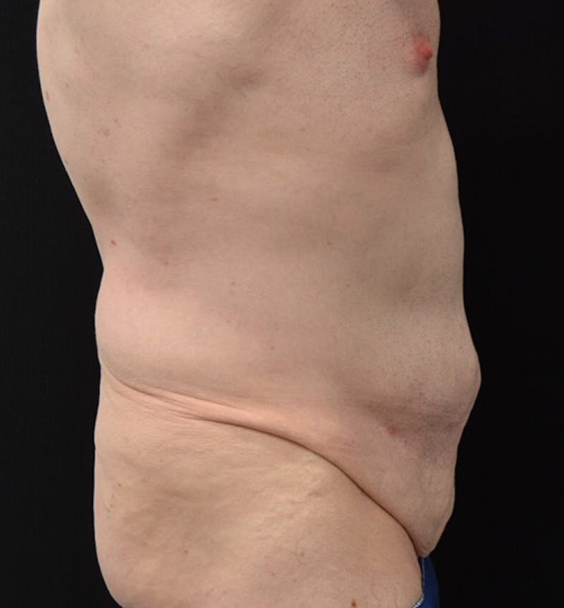Male Lower Body Lift Before & After Gallery - Patient 148037524 - Image 5
