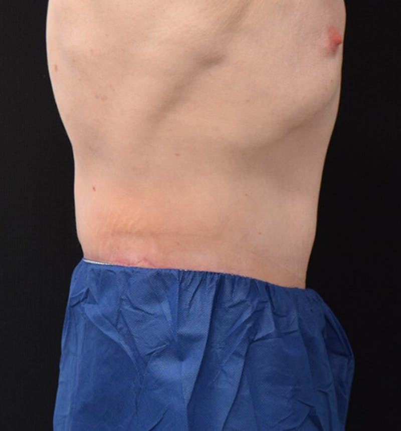 Lower Body Lift Before & After Gallery - Patient 102408256 - Image 6