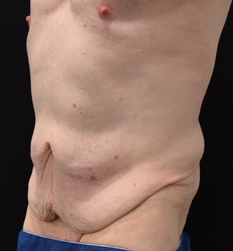Male Lower Body Lift Before & After Gallery - Patient 148037524 - Image 7