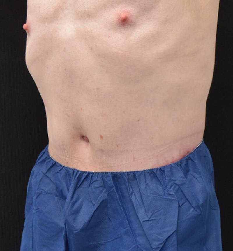 Male Lower Body Lift Before & After Gallery - Patient 148037524 - Image 8