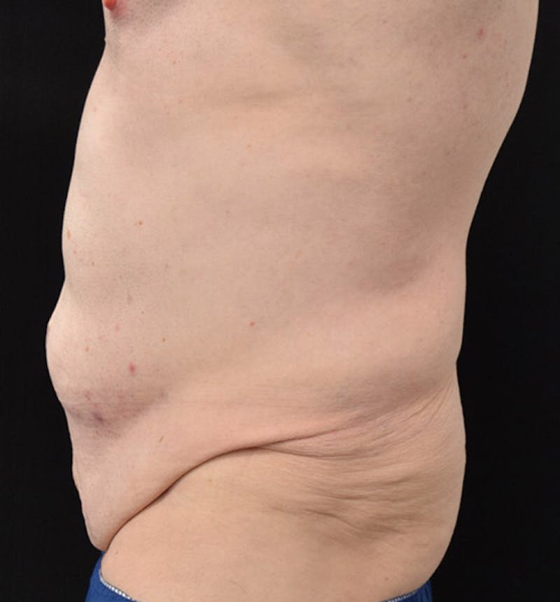 Male Lower Body Lift Before & After Gallery - Patient 148037524 - Image 9
