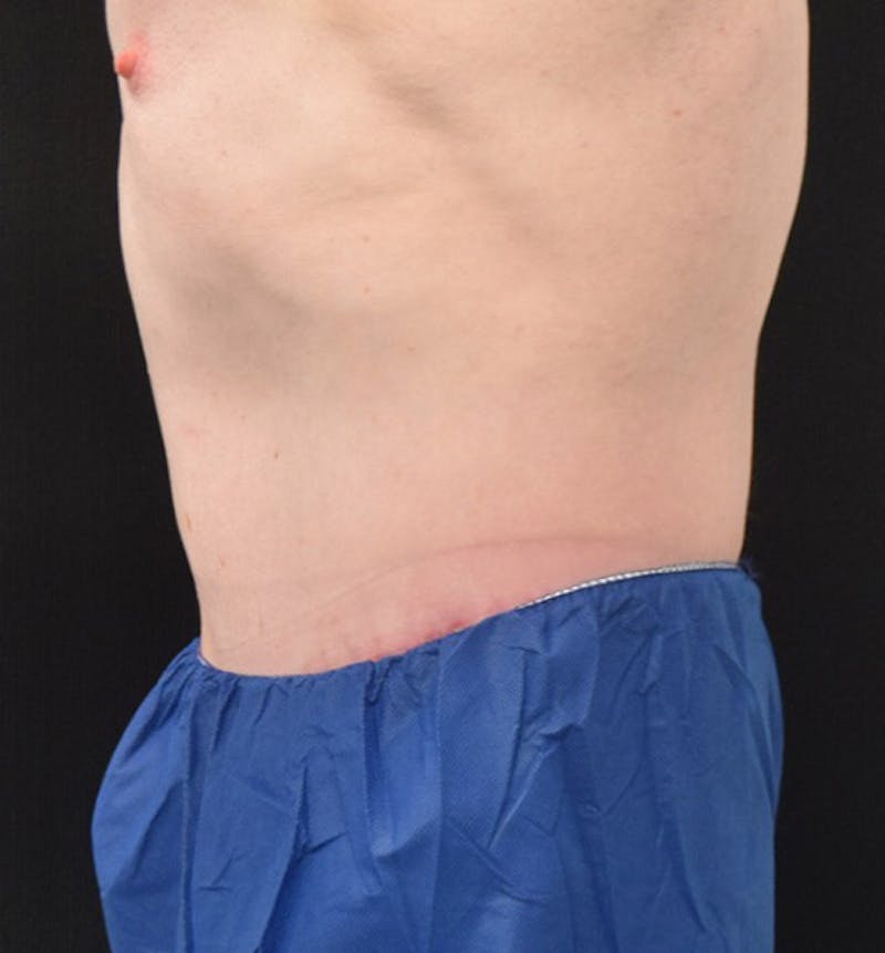 Male Lower Body Lift Before & After Gallery - Patient 148037524 - Image 10
