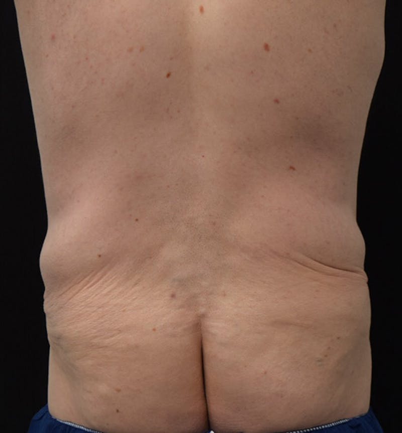 Lower Body Lift Before & After Gallery - Patient 102408256 - Image 11