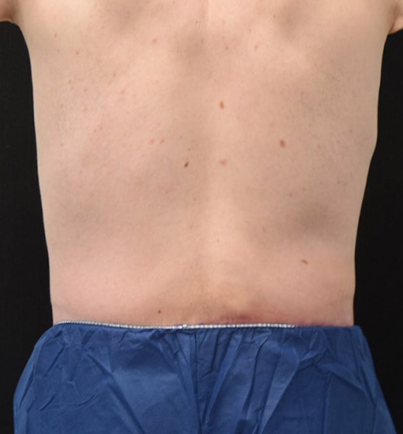 Male Lower Body Lift Before & After Gallery - Patient 148037524 - Image 12