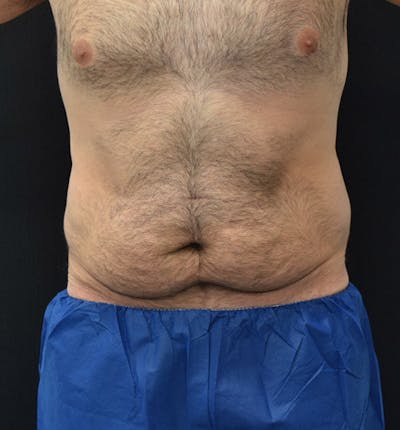 Lower Body Lift Before & After Gallery - Patient 148037525 - Image 1