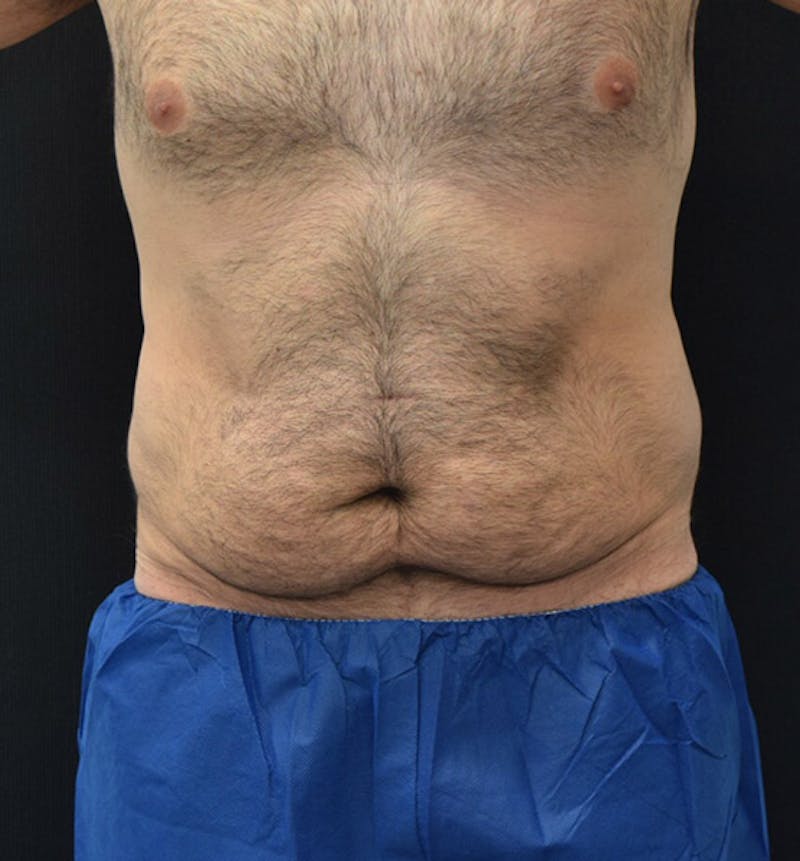 Male Lower Body Lift Before & After Gallery - Patient 148037525 - Image 1