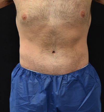 Male Lower Body Lift Before & After Gallery - Patient 148037525 - Image 2