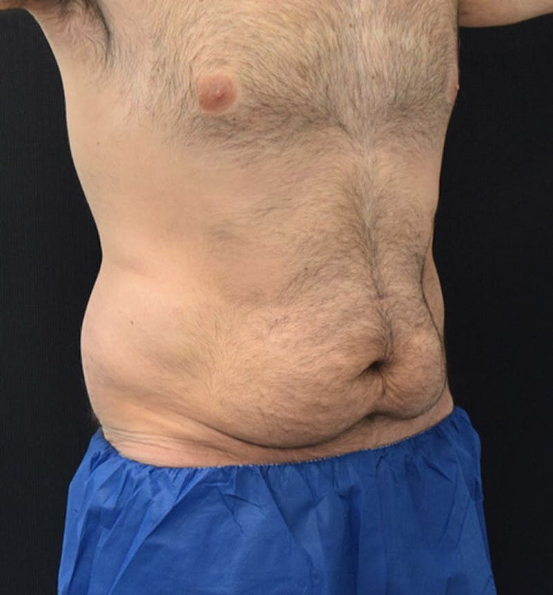 Male Lower Body Lift Before & After Gallery - Patient 148037525 - Image 3