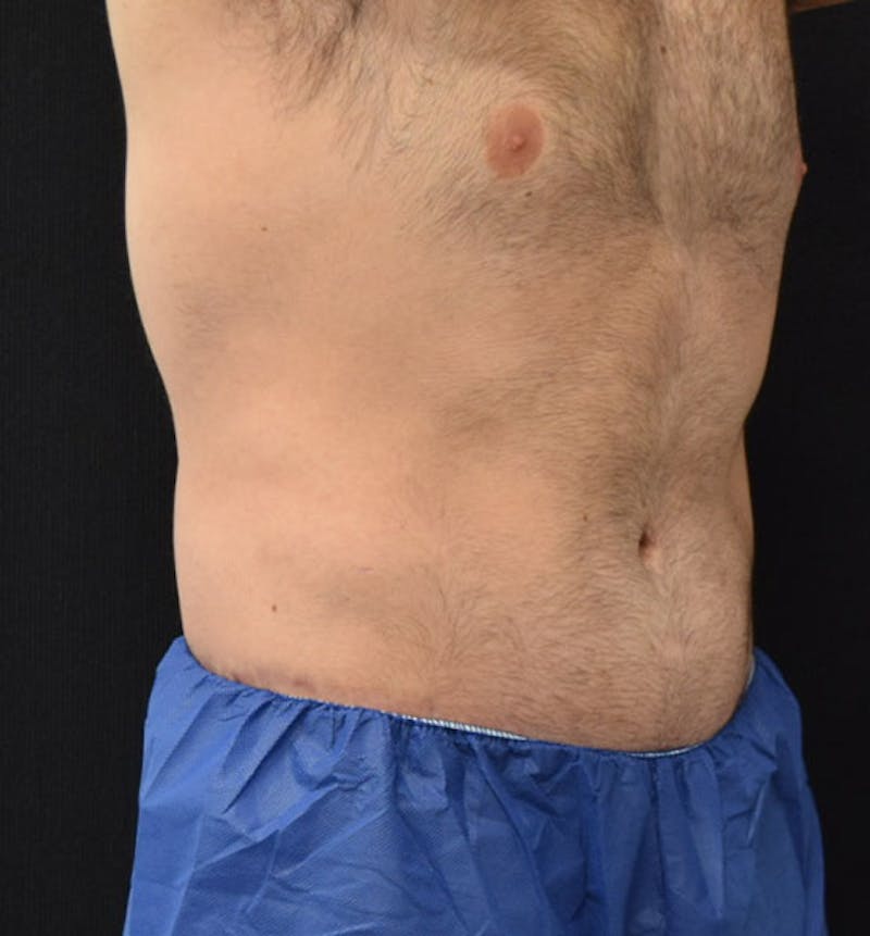 Male Lower Body Lift Before & After Gallery - Patient 148037525 - Image 4