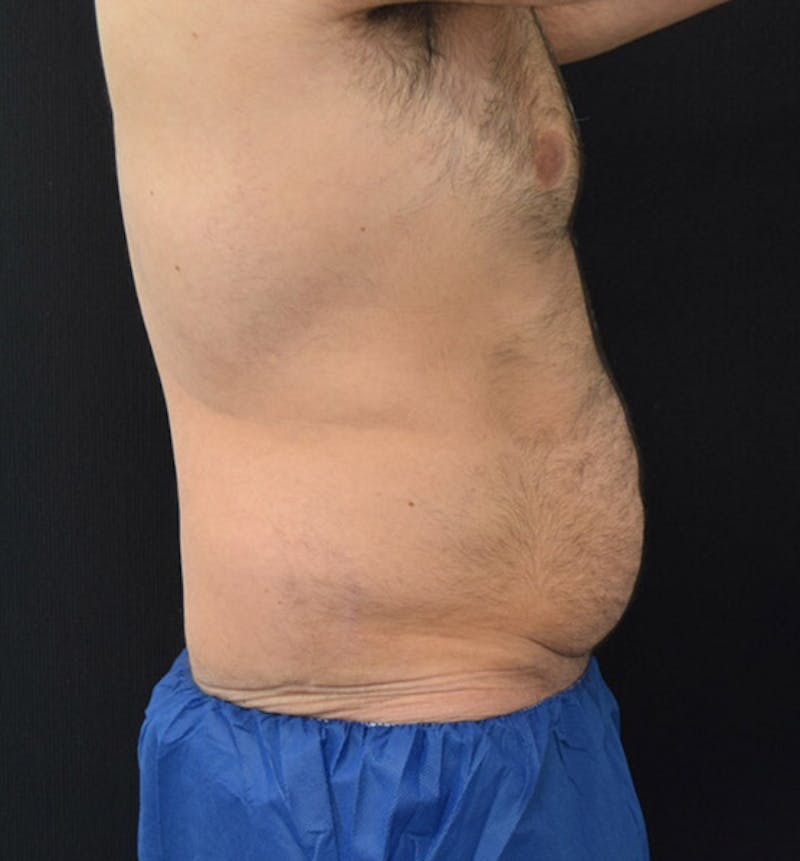Male Lower Body Lift Before & After Gallery - Patient 148037525 - Image 5