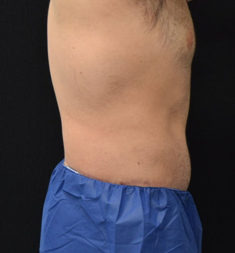 Male Lower Body Lift Before & After Gallery - Patient 148037525 - Image 6