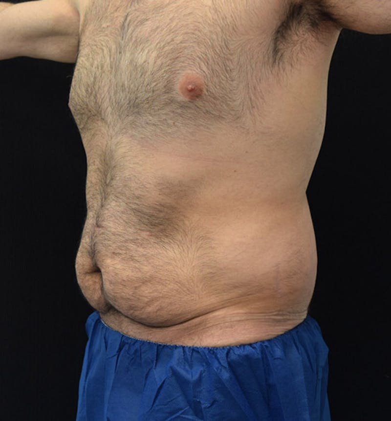 Male Lower Body Lift Before & After Gallery - Patient 148037525 - Image 7
