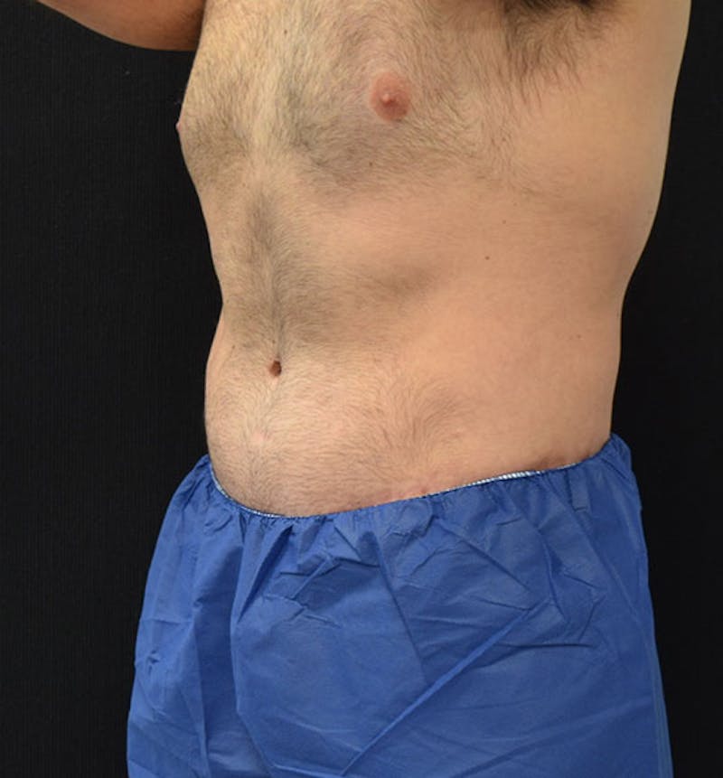 Male Lower Body Lift Before & After Gallery - Patient 148037525 - Image 8