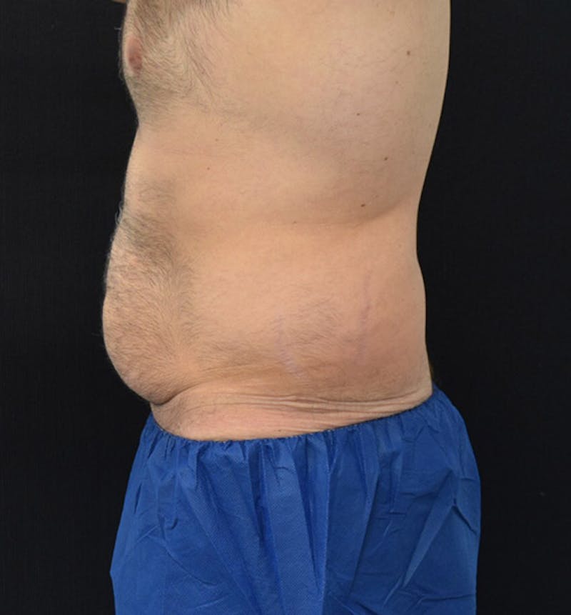 Male Lower Body Lift Before & After Gallery - Patient 148037525 - Image 9