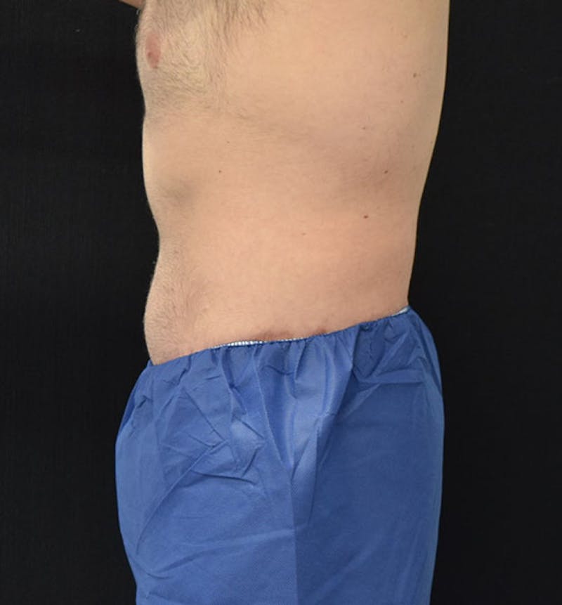 Male Lower Body Lift Before & After Gallery - Patient 148037525 - Image 10