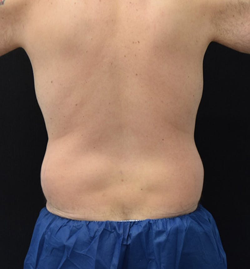 Lower Body Lift Before & After Gallery - Patient 148037525 - Image 11