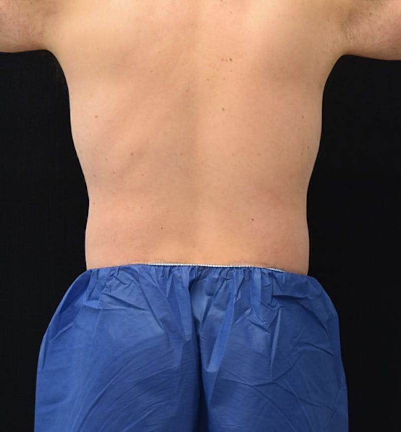 Male Lower Body Lift Before & After Gallery - Patient 148037525 - Image 12