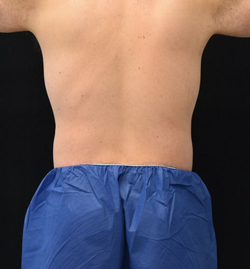 Lower Body Lift Before & After Gallery - Patient 102408270 - Image 12
