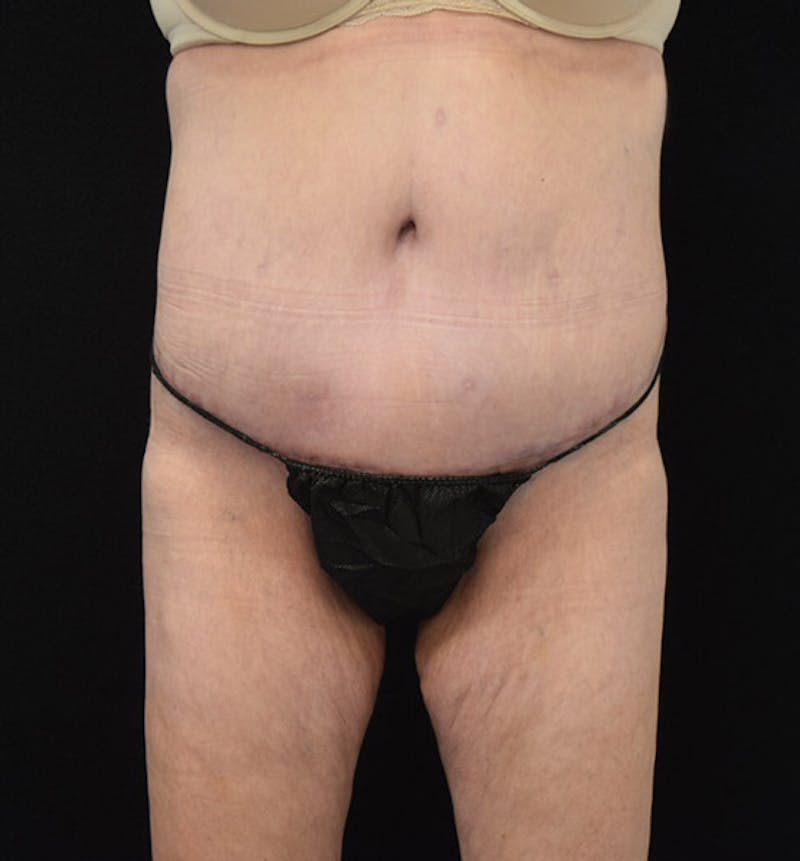 Lower Body Lift Before & After Gallery - Patient 102408280 - Image 2