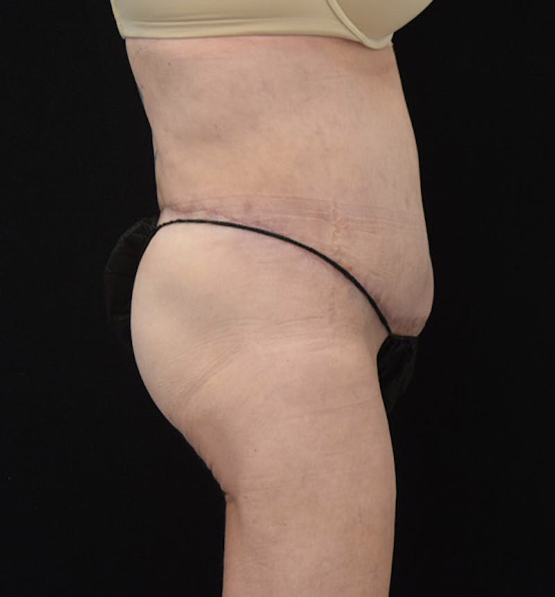 Lower Body Lift Gallery - Patient 102408280 - Image 6