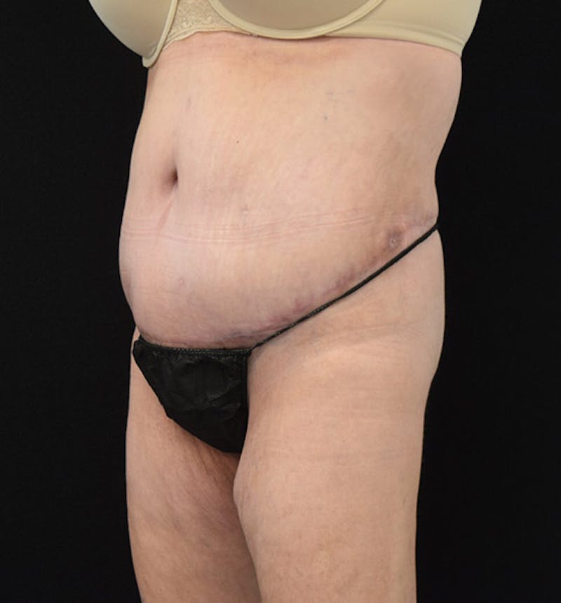 Lower Body Lift Before & After Gallery - Patient 102408280 - Image 8