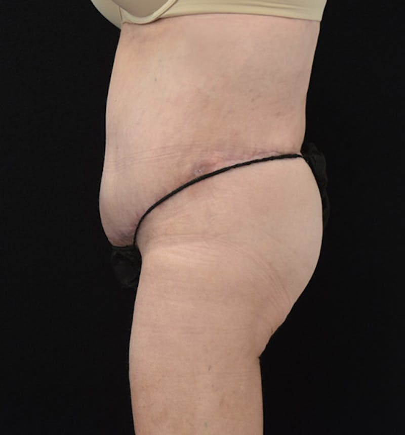 Lower Body Lift Before & After Gallery - Patient 102408280 - Image 10