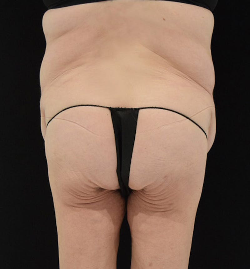 Lower Body Lift Before & After Gallery - Patient 102408280 - Image 11