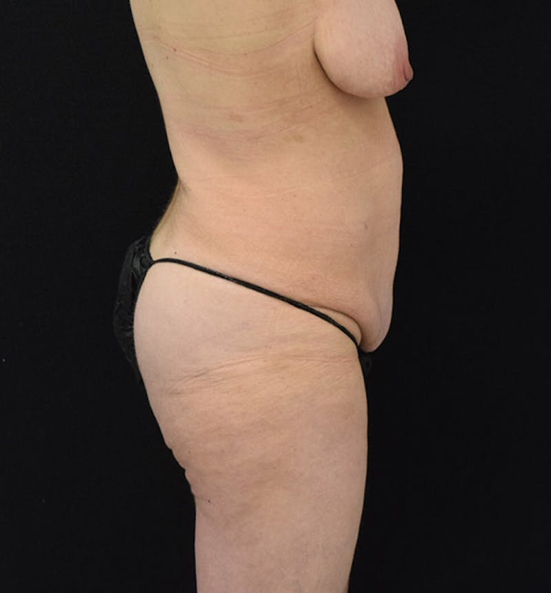 Lower Body Lift Before & After Gallery - Patient 102408305 - Image 5