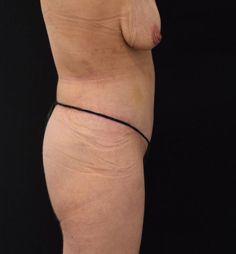 Lower Body Lift Before & After Gallery - Patient 102408305 - Image 6