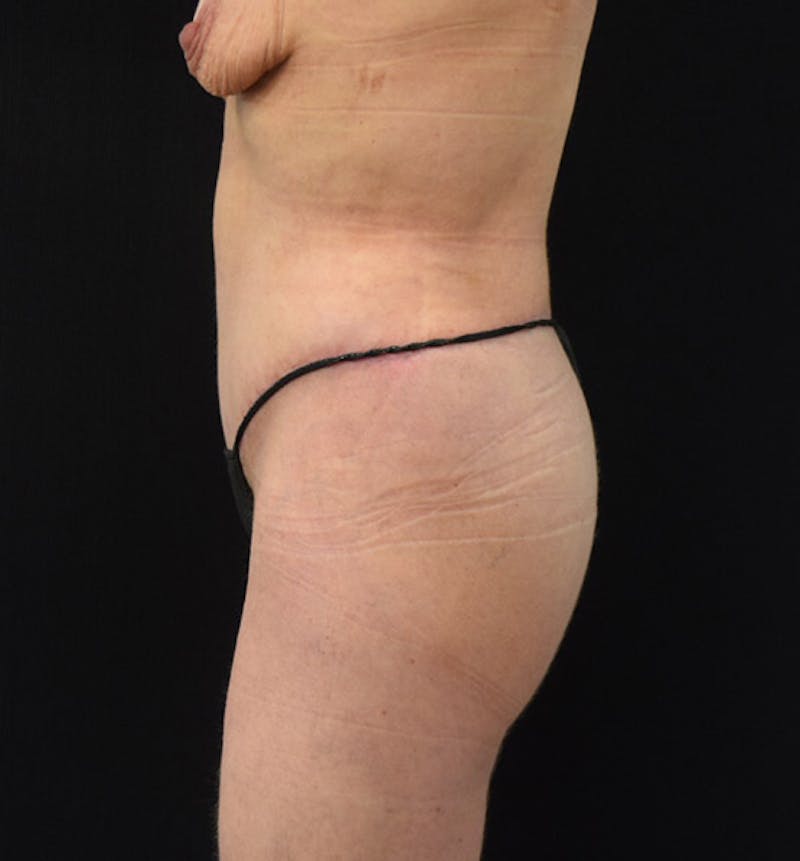 Lower Body Lift Before & After Gallery - Patient 102408305 - Image 10