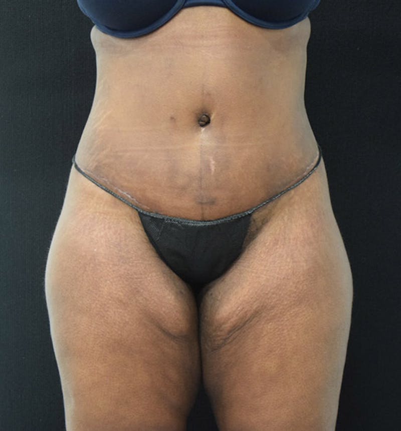 Lower Body Lift Before & After Gallery - Patient 102423515 - Image 2