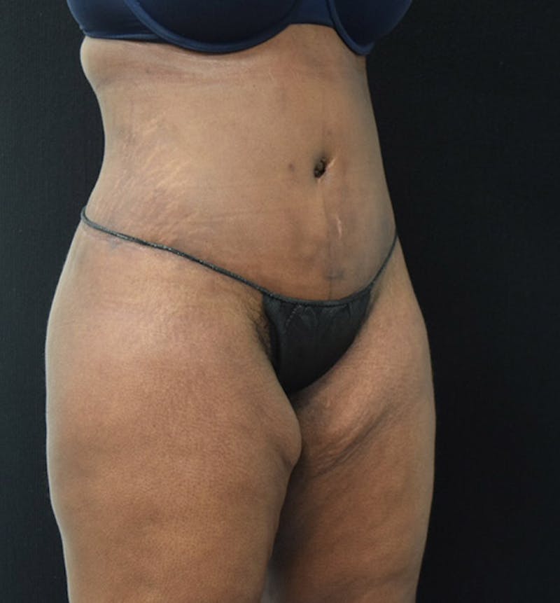 Lower Body Lift Before & After Gallery - Patient 102423515 - Image 4