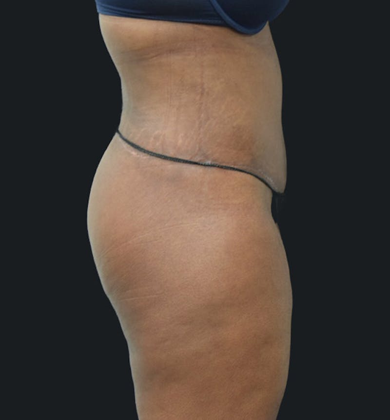 Lower Body Lift Before & After Gallery - Patient 102423515 - Image 6