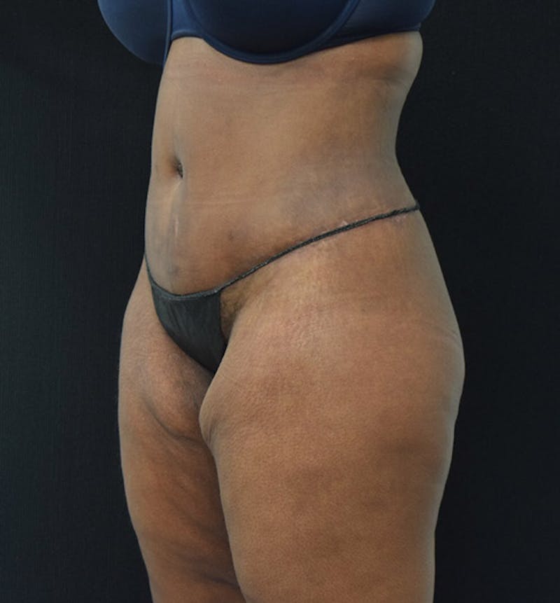 Lower Body Lift Before & After Gallery - Patient 102423515 - Image 8